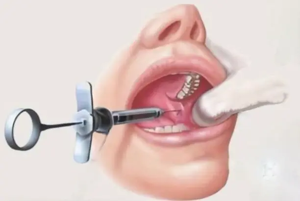 local anesthesia local anesthesia